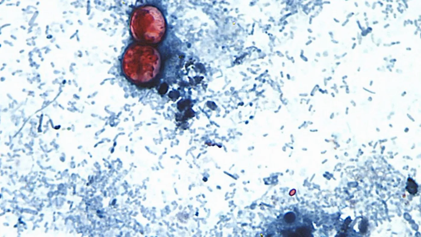 More than 20K cyclosporiasis cases suspected in US as outbreak reportedly linked to 6 more states